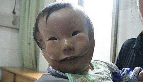两张脸的男孩康健之路两张脸男孩康康术后照片{